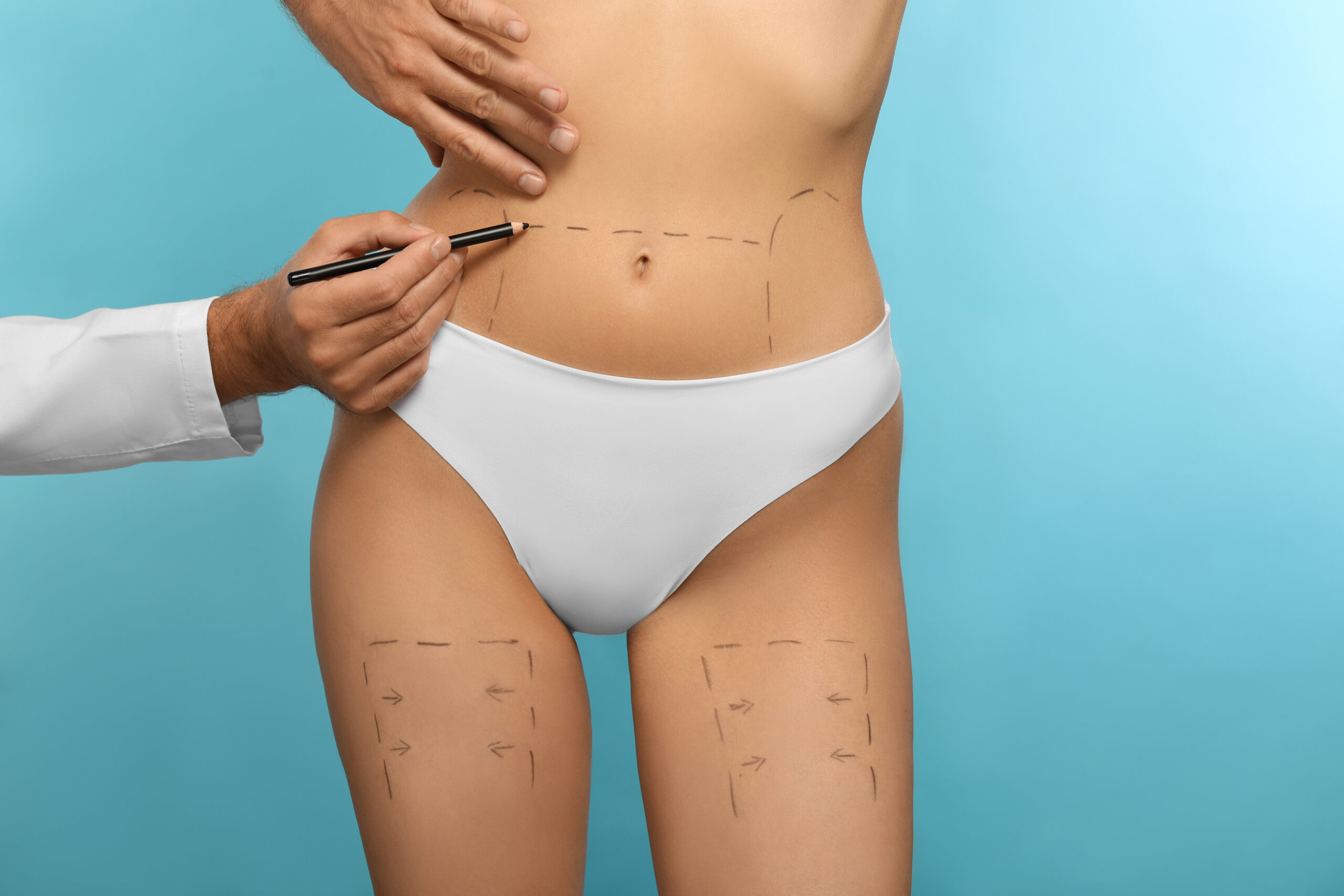 Liposuction