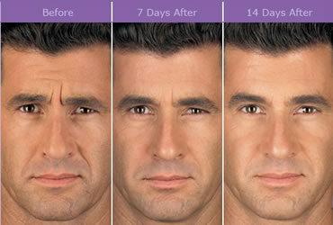 More and more men are choosing Botox treatment - Image