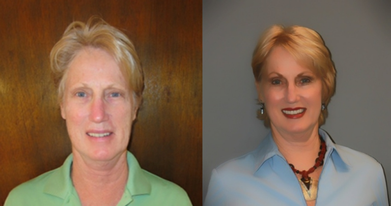 Sculptra Aesthetic Injections and Results to Expect - Image