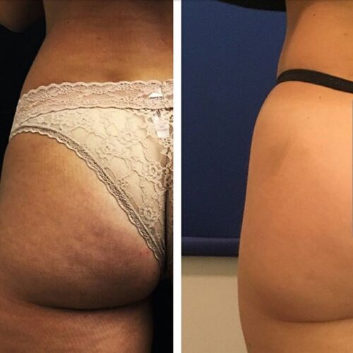 Non-Surgical BBL: Shape It Without Surgery—Tempted?