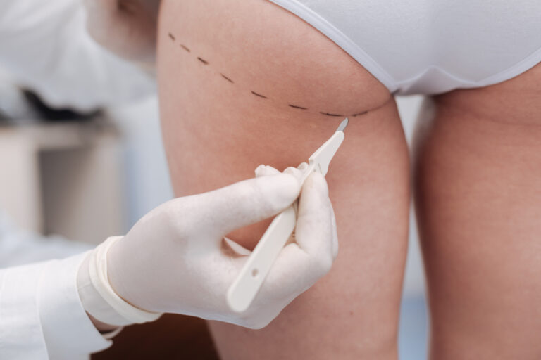 Sculptra Butt Lifts Are More Popular Than Ever! - Image