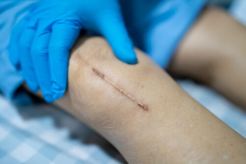 The Scar Treatment and Solutions You’ve Been Looking For